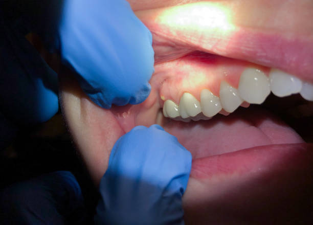 Best Emergency Treatment for Toothache in Galena, OH